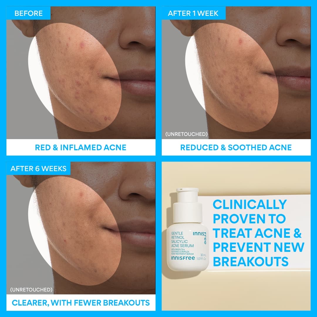 Innisfree Gentle Renewing Clarifying Blemish-Prone Skin Serum