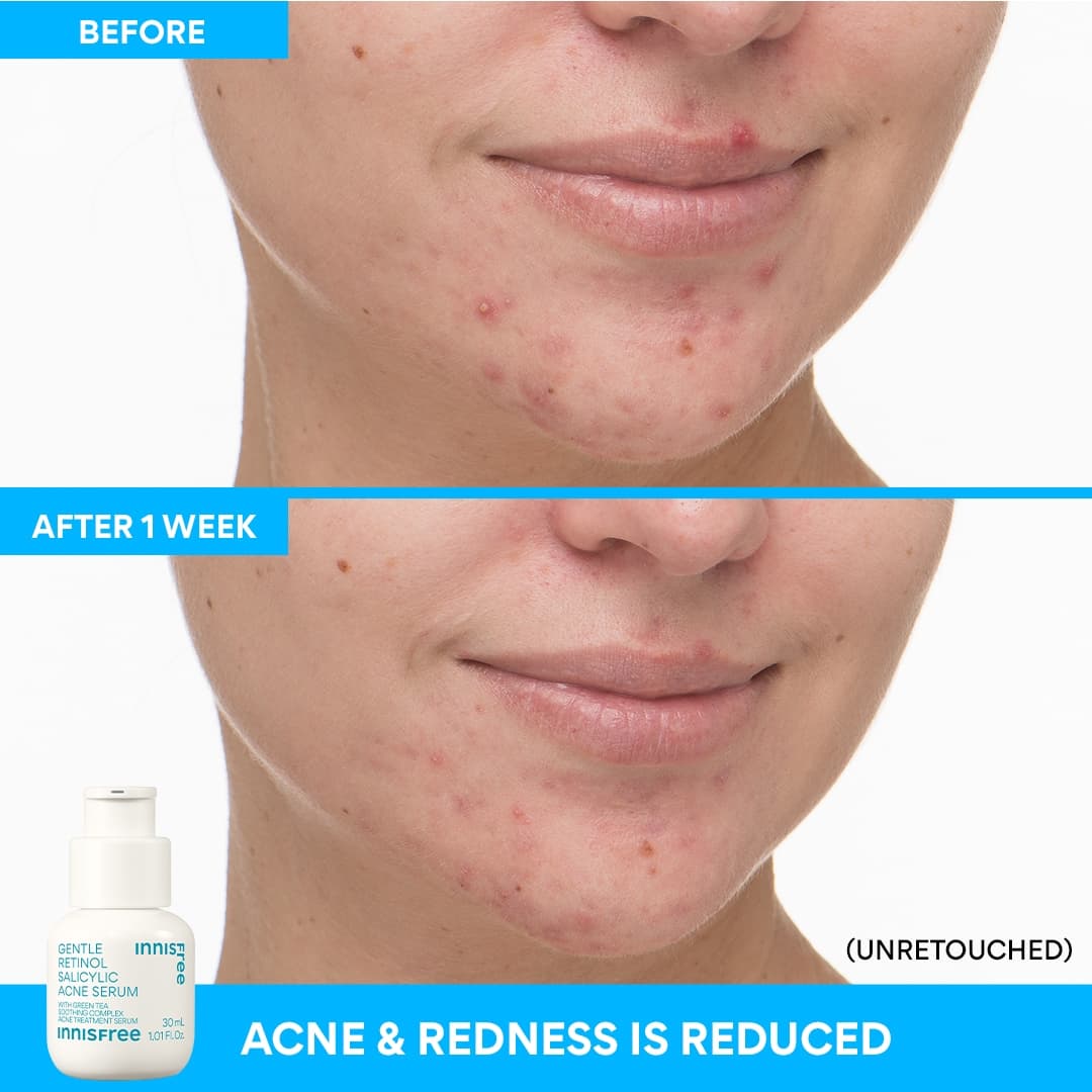 Innisfree Gentle Renewing Clarifying Blemish-Prone Skin Serum
