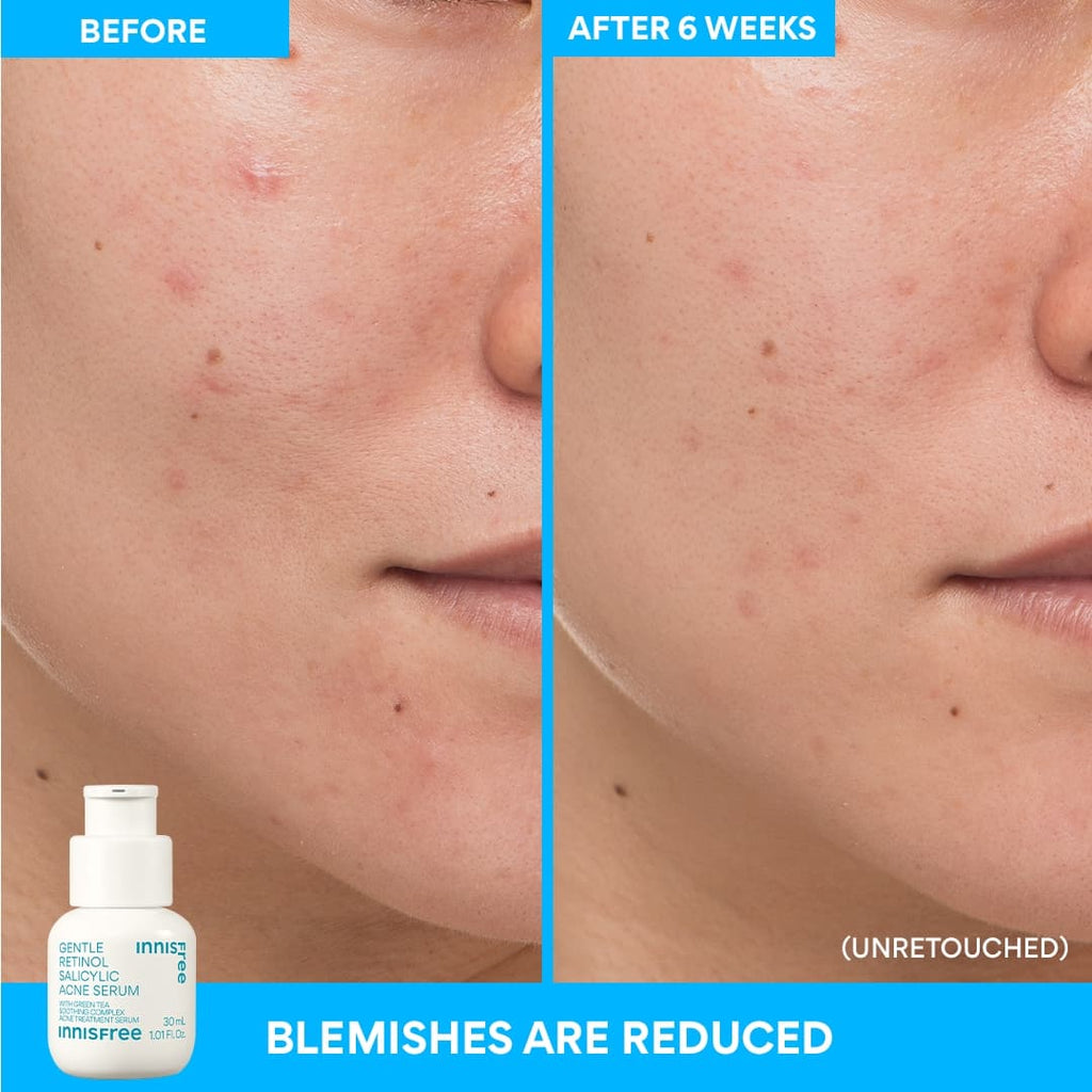 Innisfree Gentle Renewing Clarifying Blemish-Prone Skin Serum