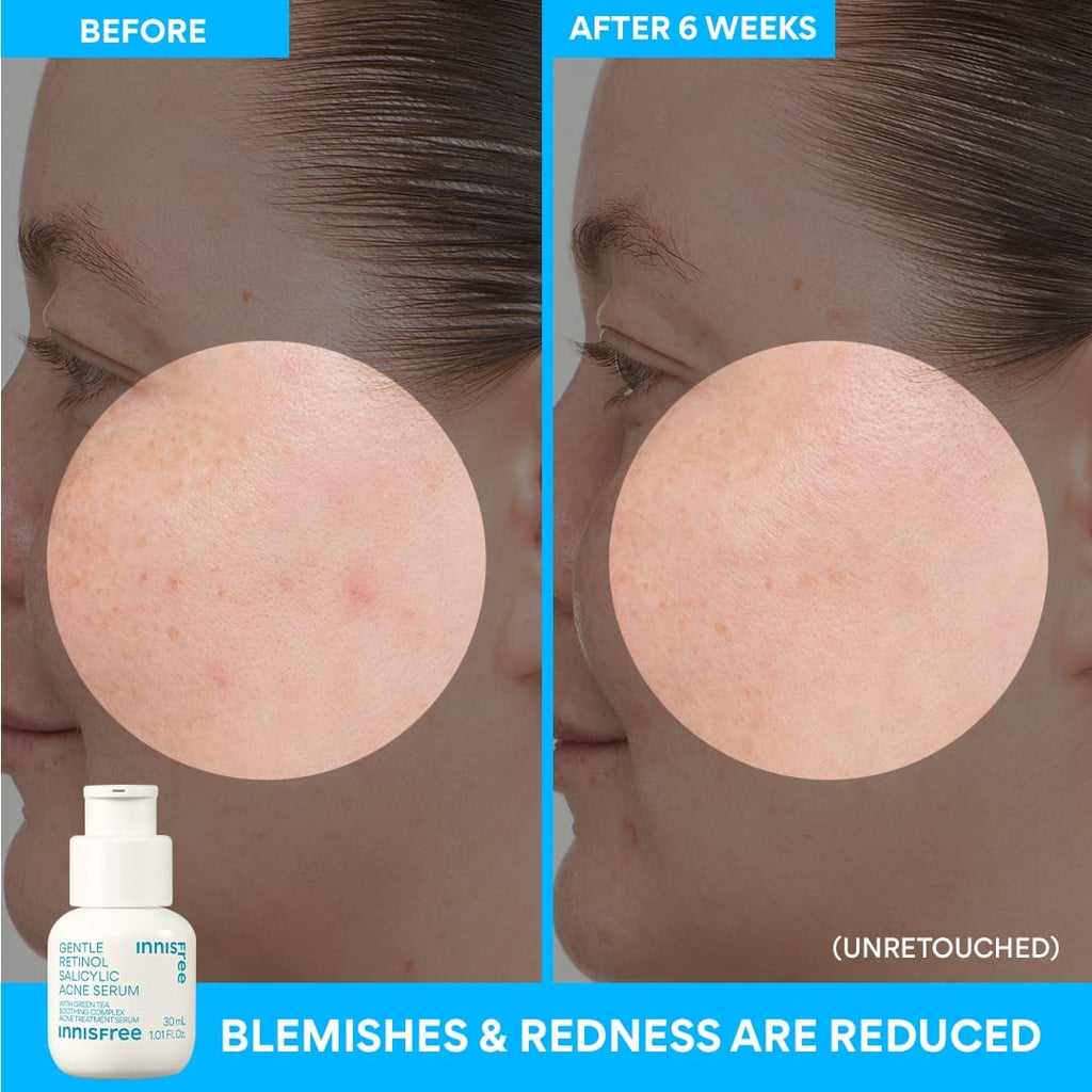 Innisfree Gentle Renewing Clarifying Blemish-Prone Skin Serum